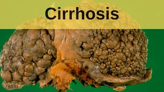 Cirrhosis  Pathology mini tutorial [upl. by Anelra295]