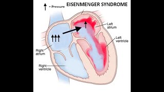 What is Eisenmenger syndrome  Circulatory System and Disease  NCLEXRN  Khan Academy [upl. by Rickert541]