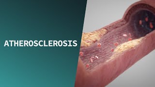 Atherosclerosis  Pathologies [upl. by Ssur438]