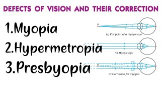 Myopia Hypermetropia Presbyopia DEFECTS IN HUMAN EYE AND THEIR CORRECTION Class 10 physics [upl. by Lessig]