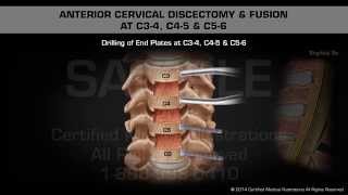 Spinal Stenosis The condition and treatment options [upl. by Algie]