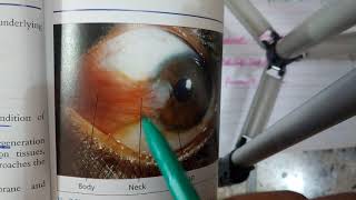 PTERYGIUM verry IMPORTANT conjuctival condition explanation with scenario [upl. by Clarine]