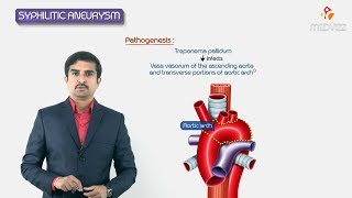 Syphilitic aneurysm  ascending aorta amp arch or aorta   Pathology Usmle step 1 Fmge and Neet Pg [upl. by Ynez]