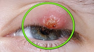 Eye Cysts  Chalazion Treatment and Causes [upl. by Akemihs]