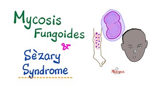 Mycosis Fungoides and Sèzary Syndrome  Hematology amp Oncology [upl. by Corene373]