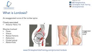 Lordosis Treatment A 3 Step Process [upl. by Lyreb]