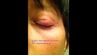 Natural Remedy for Eye Infection  Chalazion [upl. by Naesyar28]