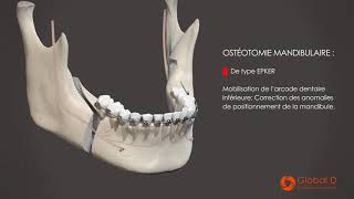 CMF  Film patient  Clivage Sagittal [upl. by Ebocaj]