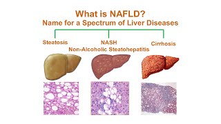 Will a Liver Cleanse Help Cirrhosis and a Fatty Liver – DrBerg [upl. by Ahsimed]