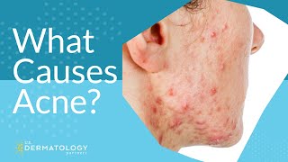 What Causes Acne  Explained by Dermatologist [upl. by Aloysius]