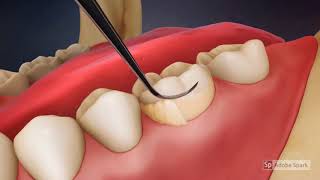 Video Tutorial Dental Scaling [upl. by Timrek]