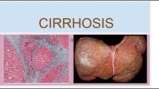 Cirrhosis [upl. by Munshi]