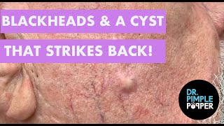 BLACKHEADS amp The Cyst that Strikes Back [upl. by Haraz99]