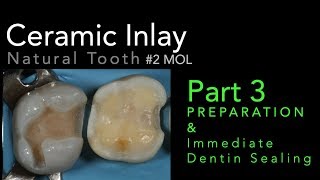 Lithium Disilicate Ceramics Part 3 Preparation and Immediate Dentin Sealing IDS [upl. by Ora]