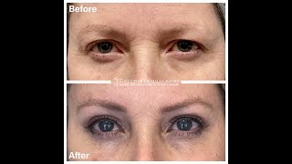 Before and After Endoscopic Brow Lift and Blepharoplasty Surgery [upl. by Ydnas]