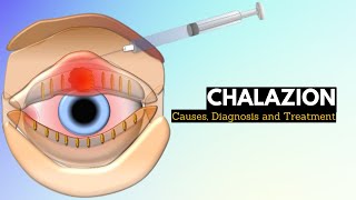 CHALAZION Causes Signs and Symptoms Diagnosis and Treatment [upl. by Rehtaeh]