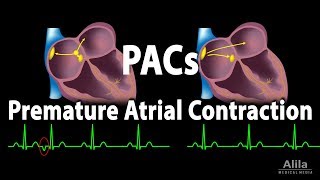 Premature Atrial Contractions PACs Animation [upl. by Toddy]