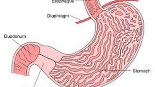 Pyloric Stenosis [upl. by Asilam]