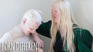 The Besties With Albinism  BORN DIFFERENT [upl. by Ileak158]