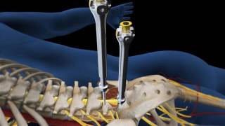 Lumbar Fusion of L5 S1 Animation [upl. by Whitby]