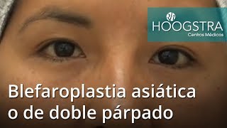 Blefaroplastia asiática o de doble párpado 19009 [upl. by Ardekahs]