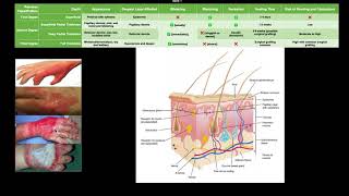 Classifying Burns EXPLAINED [upl. by Blasien]