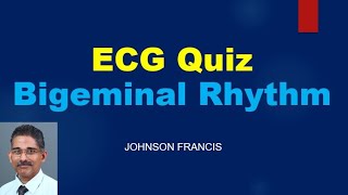 ECG Quiz  Escape – Capture Bigeminy [upl. by Suilienroc]