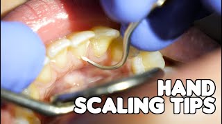 Dental Cleaning  Hand Scaling Tips [upl. by Atalya]