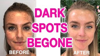 THE ULTIMATE DARK SPOT REMOVER GUIDE [upl. by Lev]