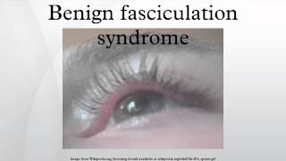 Benign fasciculation syndrome [upl. by Bevus]