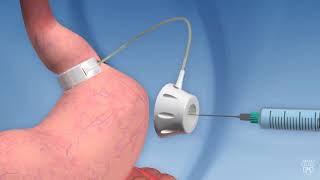 Laparoscopic adjustable gastric banding [upl. by Phemia]