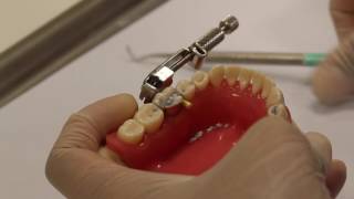 Class II amalgam cavity preparation amp restoration [upl. by Murray]