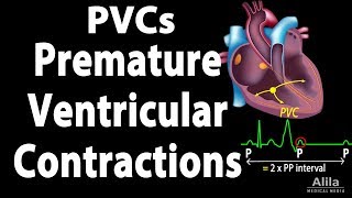 Premature Ventricular Contractions PVCs Animation [upl. by Ainoet]