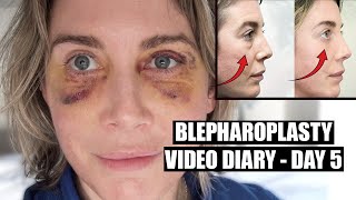 Blepharoplasty Video Diary  Day 5 After Surgery 4 of 15 [upl. by Tabb]