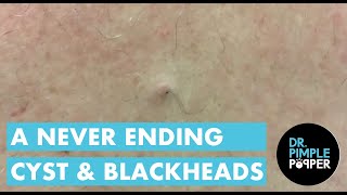 A Never Ending Cyst and Blackheads [upl. by Diskin]