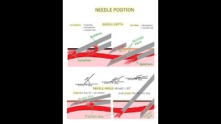 Venipuncture  How to Position a Needle [upl. by Nywde]