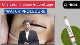 CHALAZION  Chalazion Excision  INCISION amp CURETTAGE  surgery video  opthalmology [upl. by Leifer]