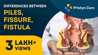 Differences Between Piles Fissures and Fistula in Tamil  For Free Appointment Call on 6366526460 [upl. by Sargent]