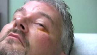 Chalazion Injection Demonstration [upl. by Nivrek]