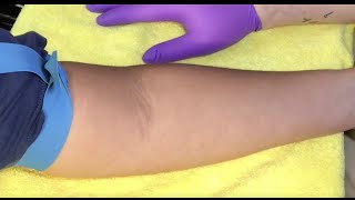 Tips For Locating Difficult Veins [upl. by Barmen]