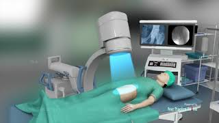 Core Decompression for Avascular necrosis of HipAVN [upl. by Miehar]