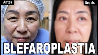 BLEFAROPLASTIA  Preço  Pós Operatório  Antes e Depois  VALE A PENA [upl. by Faro]