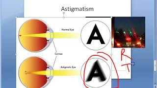 Ophthalmology 044 a Refractive Errors Of Refraction Emmetropia Ametropia Myopia HyperMetropia Eye [upl. by Kcire768]